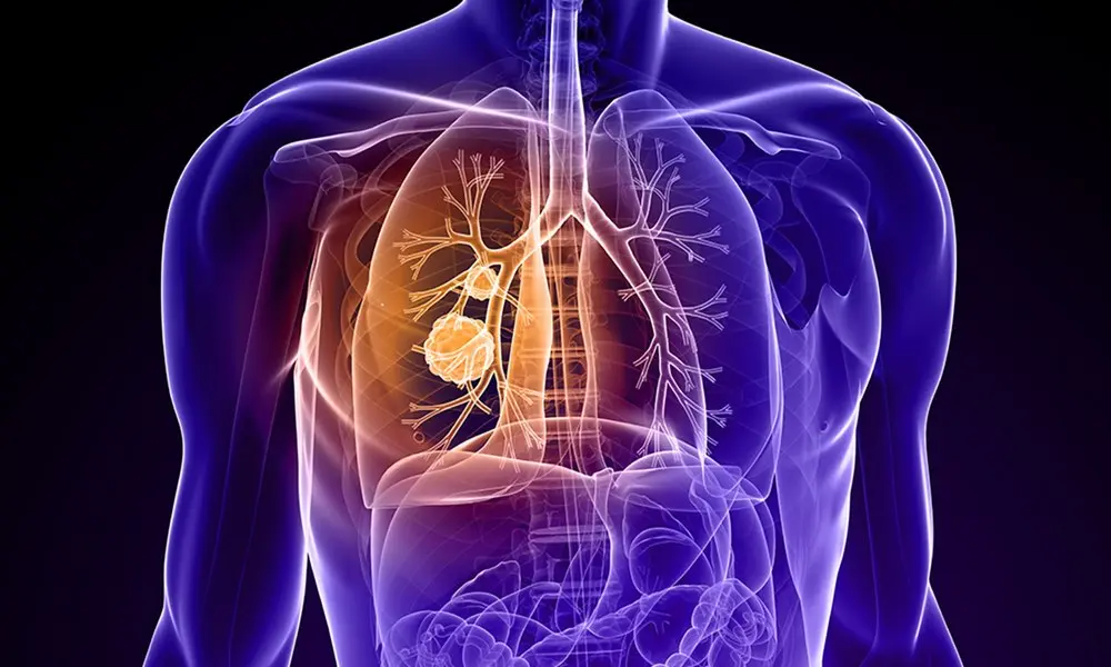 Combinație de medicamente reduce cu 58% riscul de deces la pacienții cu cancer pulmonar