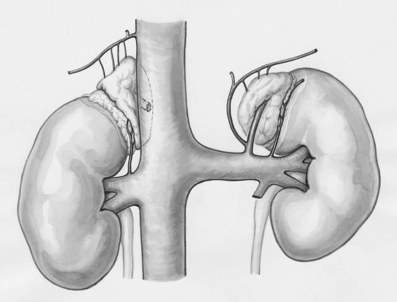 Proteinele joase cresc riscul de eșec renal la pacienții cu BCR